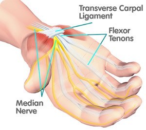 Carpal tunnel syndrome - London Elbow Surgeon